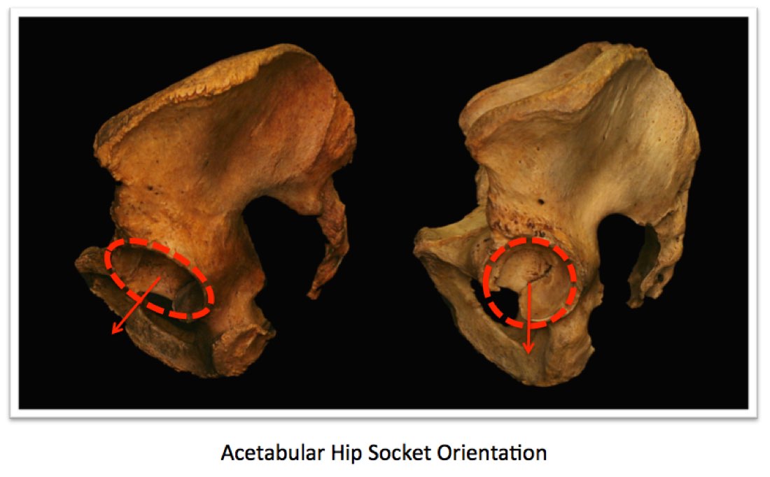 Acetabular pelvic bone variations