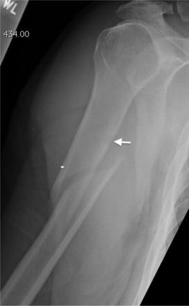 humerus fracture after biceps tenodesis