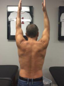 Improving Overhead Shoulder Mobility