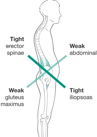 Do Tight Hip Flexors Correlate to Glute Weakness?