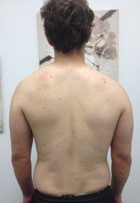 Scapular posture assessment