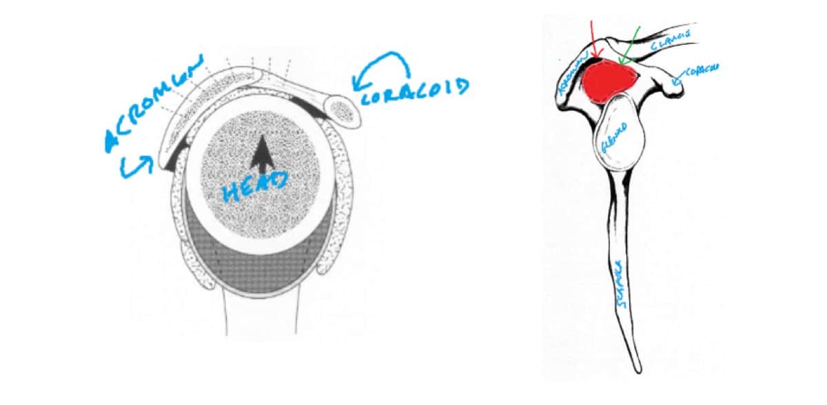 Shoulder impingement