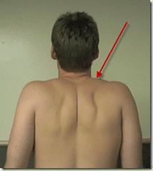 upper trapezius