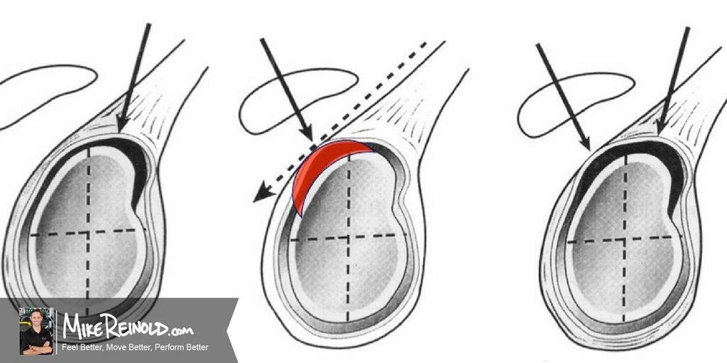 slap tear lesion labral spalla mikereinold chirurgico