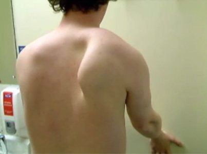 5 Tips for Treating Scapular Winging