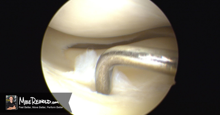 Physical Therapy or Surgery for a Meniscus Tear?