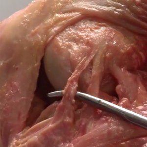 anterolateral knee ligament