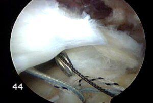 How to Enhance Your Success After Rotator Cuff Repair Surgery