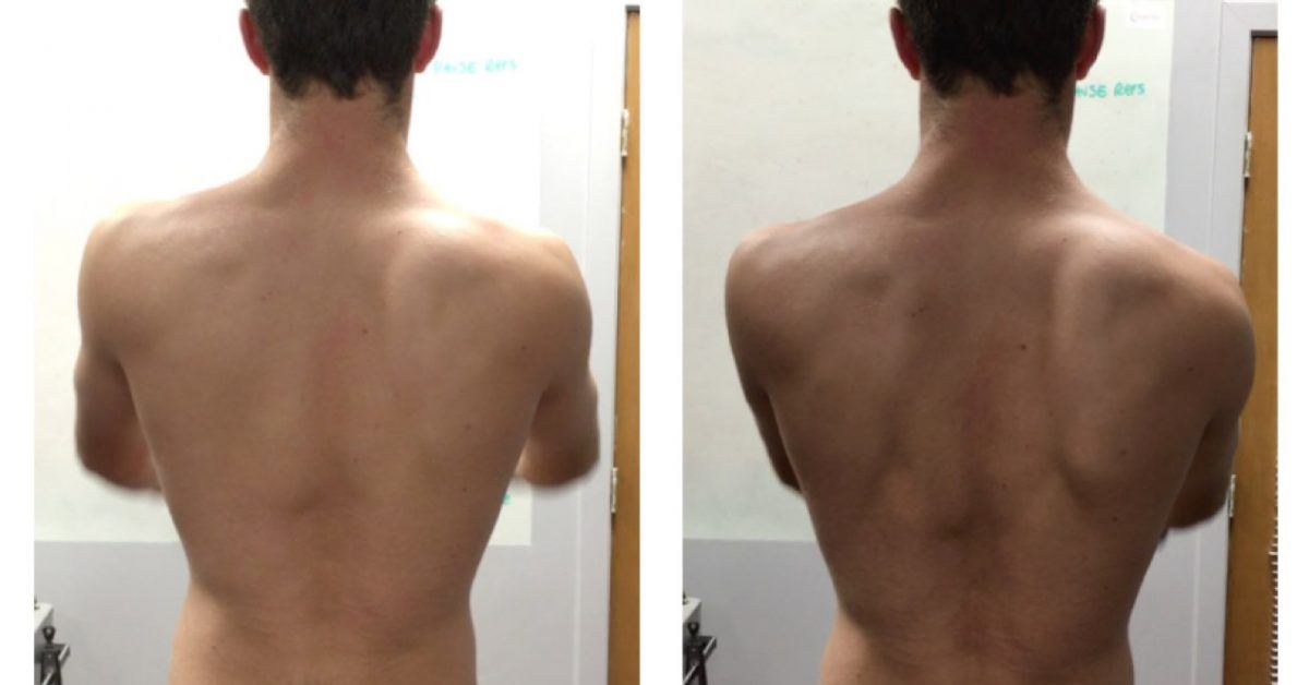 A Simple Test for Scapular Dyskinesis You Must Use