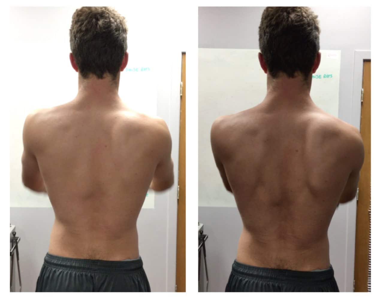 A Simple Test For Scapular Dyskinesis You Must Use