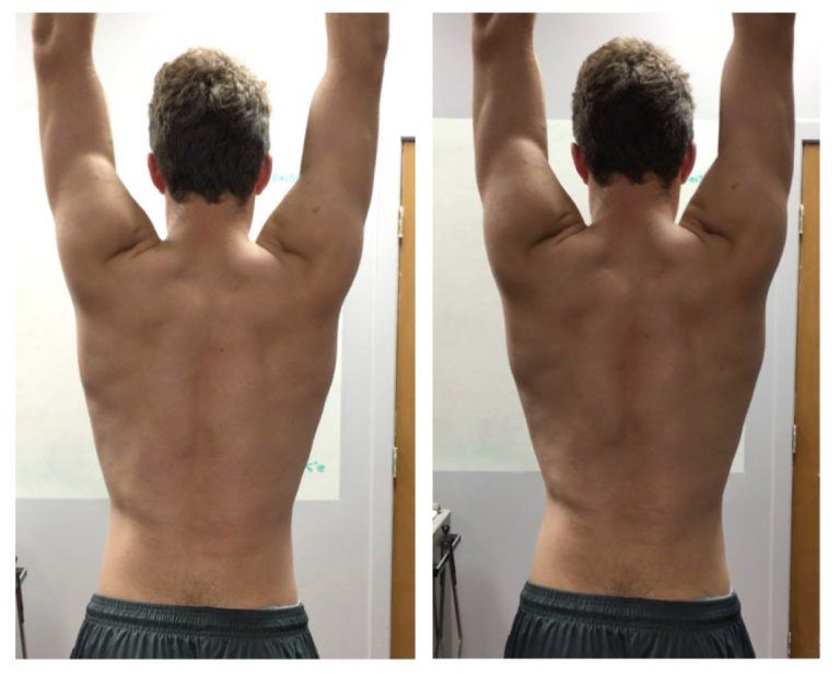 Assessing Dynamic Shoulder Mobility and Scapular Dyskinesis