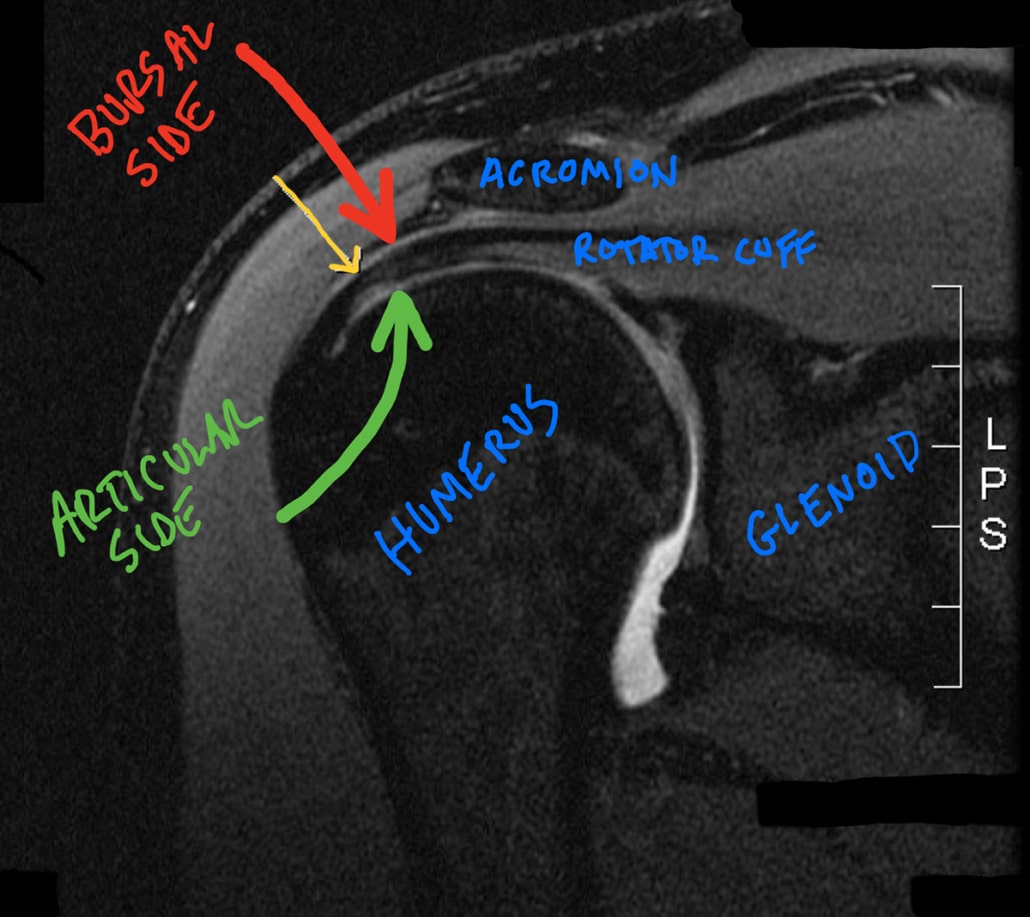shoulder impingement - bursal articular side