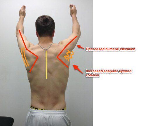 teres-major-an-important-muscle-that-is-often-overlooked